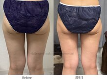 スラリ(SLARI)/【太もも　脂肪冷却】