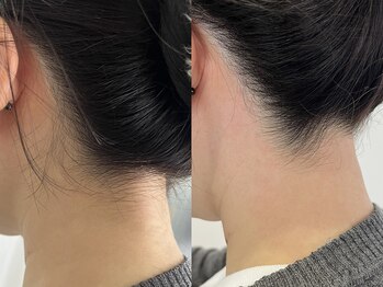 シロ(Shiro)/MIX脱毛うなじデザイン