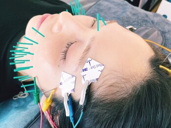 アオヤマ サロン ワイゼット(AOYAMA SALON YZ)の写真/《電気を流す美容鍼が大得意☆》顔の歪みから整えてサイズダウン！爆速リフトアップ小顔へ！
