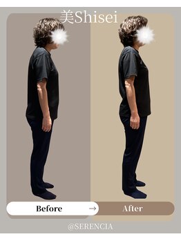 セレンシア(SERENCIA)/2回の施術で別人に!