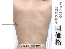 フェイシャルヴィム(FACIAL VIM)/10回施術後