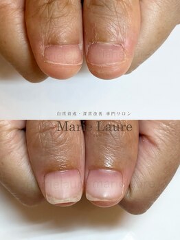 マリーロール 梅田店(Marie Laure)/深爪矯正/自爪育成/自爪風