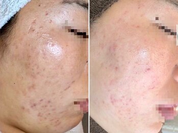 リッチ(Rich+)/ニキビケア・毛穴ケア