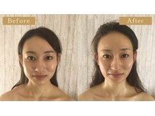 モモスパ(MOMOspa.)/頭蓋骨小顔矯正ビフォアフター