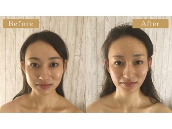 モモスパ(MOMOspa.)/頭蓋骨小顔矯正ビフォアフター