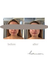 ハリムーン 仙台(harimoon)/美容鍼灸ビフォーアフター