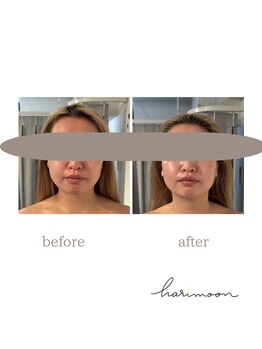 ハリムーン 仙台(harimoon)/美容鍼灸ビフォーアフター