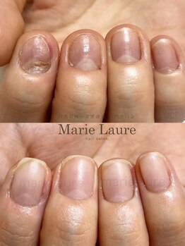 マリーロール 淀屋橋本店(Marie Laure)/自爪育成/深爪矯正/ネイルケア