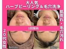 イーラボ 池袋店(e-LABO)/毛穴洗浄×国産ハーブピーリング