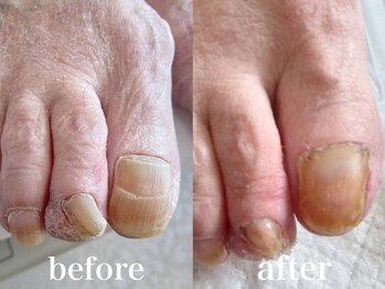 ドクターネイル爪革命 札幌本店/症例紹介6 肥厚爪