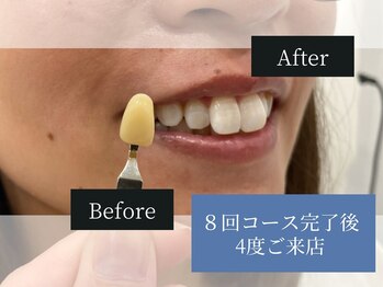 ホワイトニングカフェ 中野店(WhiteningCafe)/◎歯のホワイトニング施術写真◎