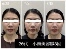 ラムーン(La.Moon)/小顔・美容鍼８回