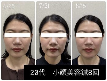 ラムーン(La.Moon)/小顔・美容鍼8回