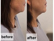 エクラリール(eclat rire)/二重アゴ改善