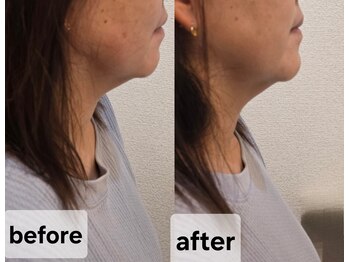 エクラリール(eclat rire)/二重アゴ改善