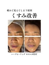 成宮鍼灸整骨院/ビフォーアフター（くすみ改善）