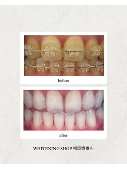 ホワイトニングショップ 福岡香椎店/美容ホワイトニング