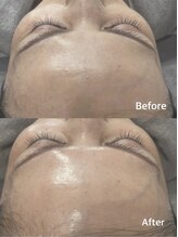 リアン(Lien)/《ララピール》Before/After