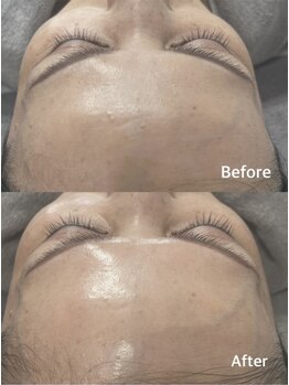 リアン(Lien)/《ララピール》Before/After