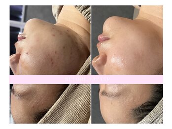 ニコ(nico)/美肌で別人級の変化!