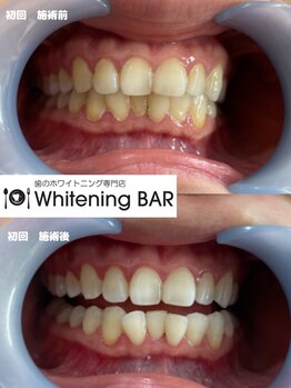 ホワイトニングバー 高崎店/初回で2トーンアップ