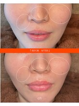 サンク(cinq)/お肌を育てるララピール☆彡