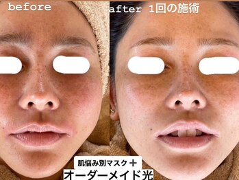 リノアンド(Lino&)/最新光フォトと肌悩み別マスク