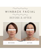 さかうえ接骨院/【BF/AF】WINBACKフェイシャル　