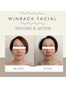 さかうえ接骨院/【BF/AF】WINBACKフェイシャル　