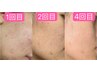 【ゆらぎ肌/ごわ肌/疲れ肌に】肌回復＆ターンオーバー80分￥12,000円（税込）