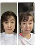 【モニター価格】小顔矯正　頭蓋骨矯正