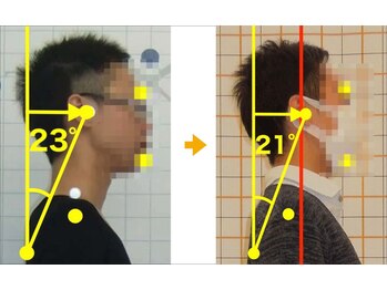 リファイン(Refine)/頭部前方(TE角)男性2