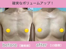 知らないと損！他店にはない！サラ・エクの強みと選ばれる理由、一般的なバストアップ法との比較