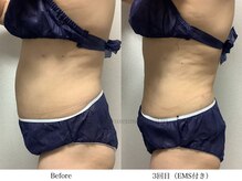 スラリ(SLARI)/【腹部　脂肪冷却】