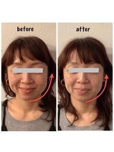 トリート(TREAT)/ビフォー&アフター　K様(お顔）