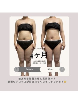 エスラージュ(esoulage)/脂肪冷却　Before After