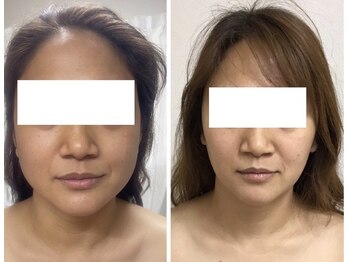 レミュー/話題のレモンボトルリフト♪