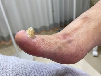 フットメンテ 巻き爪矯正センター 南浦和/肥厚爪