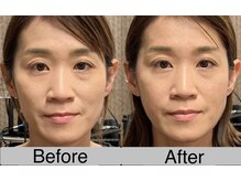あおき鍼灸整骨院/小顔美容鍼　施術1回効果