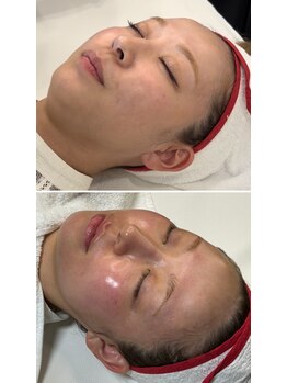 ミヨン(Miyong)/スーパージェクション