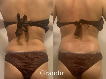 グランディール(GRANDIR)/【痩身】上半身コース3回