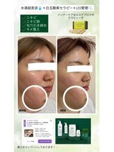 ココリル(cocorire)/水滴超音波LDM