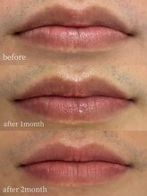 ラミパス(LAMIPAS)/ローマピンク　症例　1ヶ月後