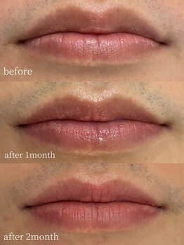 ラミパス(LAMIPAS)/ローマピンク　症例　1ヶ月後