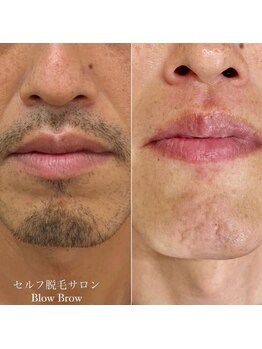 ブロウブロウ(Blow Brow)の写真/《美肌と脱毛を同時に叶える◎》他店で満足できなかった方にもおすすめ♪保湿ケアまで丁寧に施術致します☆