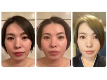 アールビューティーバランス 府中店の雰囲気（1回でこの効果！施術前⇒施術直後⇒翌朝）