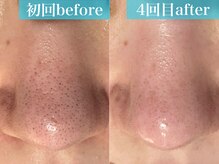 ルアナ(Luana)/【毛穴／産毛タイプ】