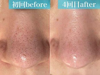 ルアナ(Luana)/【毛穴／産毛タイプ】