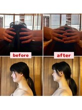 アリュール(ALLURE)/小顔リフトインディバ・小手指