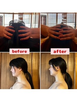 アリュール(ALLURE)/小顔リフトインディバ・小手指